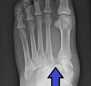 Fratura de Lisfranc