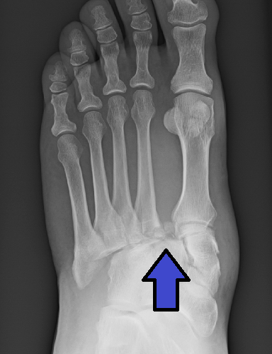 Fratura de Lisfranc