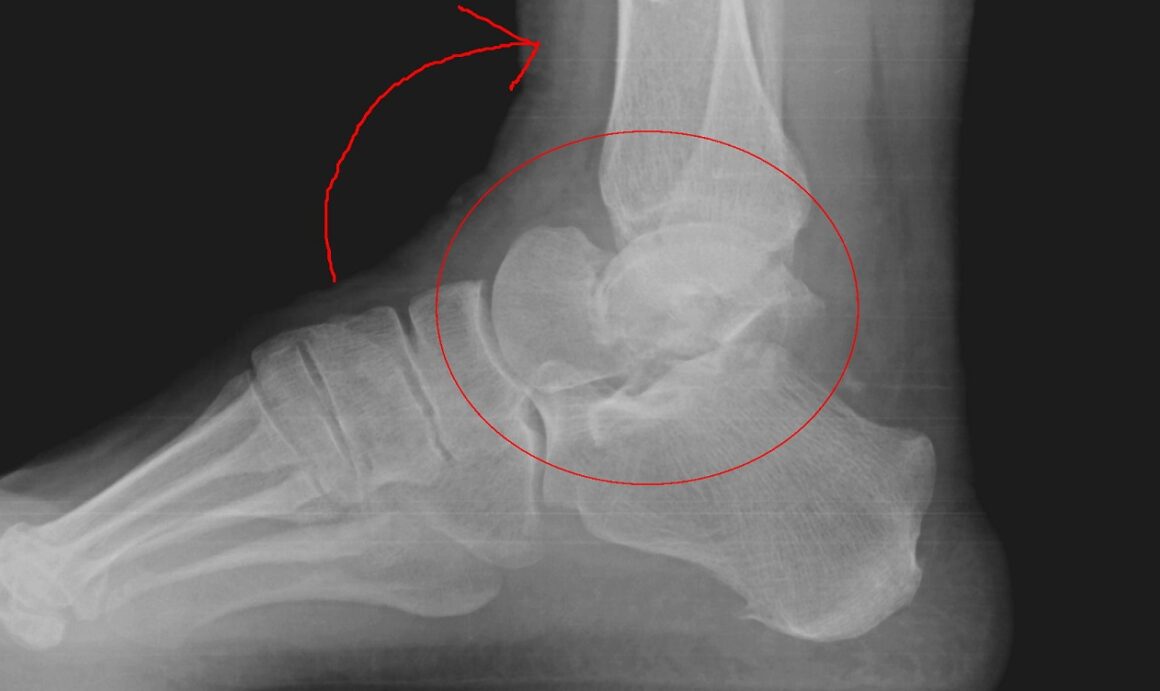 talus fracture treatment